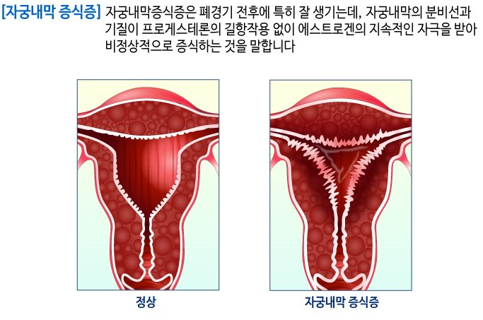 자궁 내막증 증상