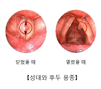 성대 용종 출처 서울 아산 병원 홈페이지