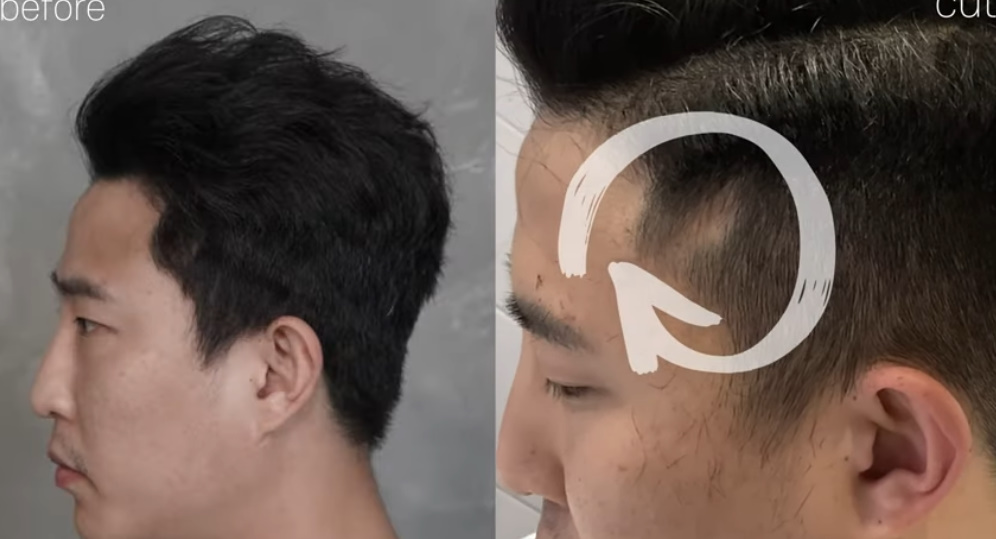  문신으로 두피 흉터 없애기 {그레이시티 스칼프}