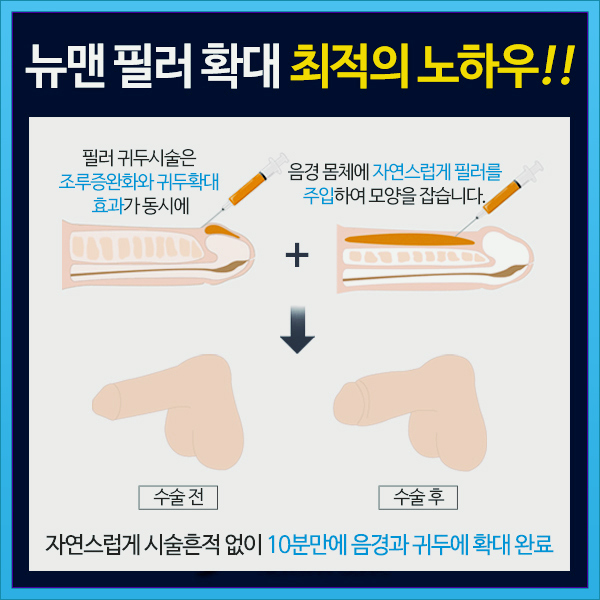 음경필러 메가필 특징 및 비용은?!