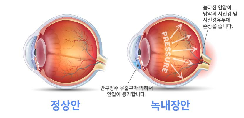 녹내장