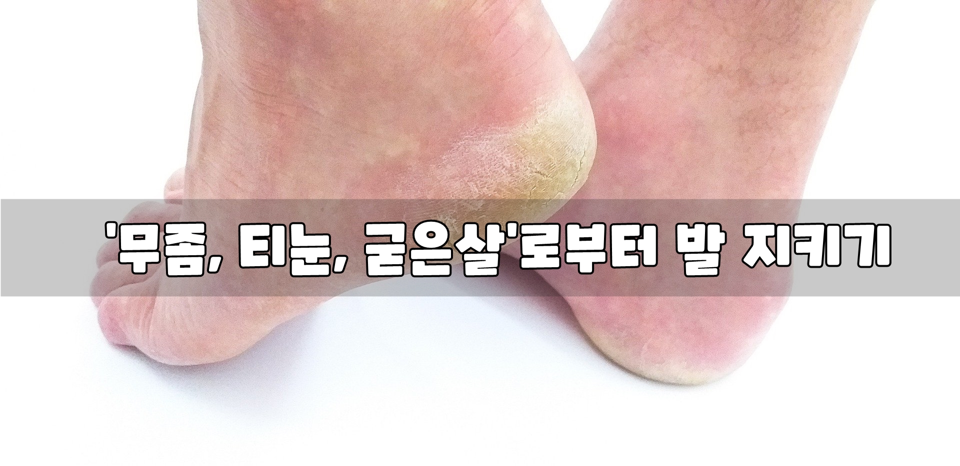  '무좀, 티눈, 굳은살'로부터 발 지키기