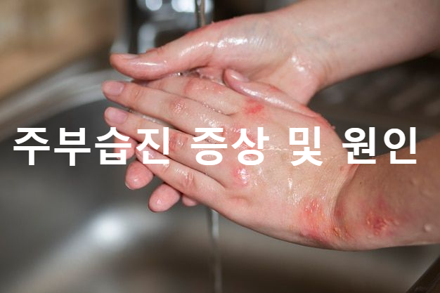  주부습진 - 증상 및 원인 , 방치하면 망가지는 손 ?