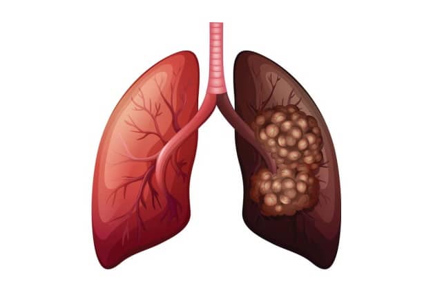 폐암 썸네일