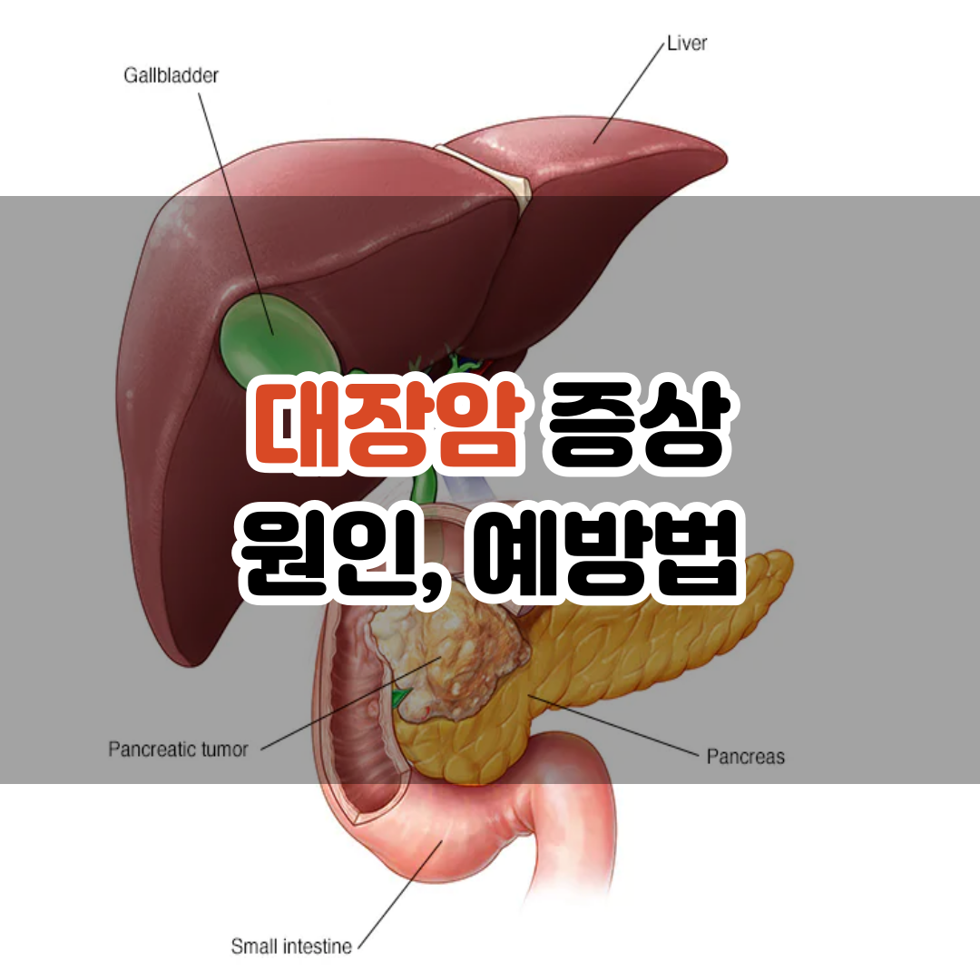 대장암 초기증상