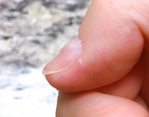 爪が死んでる からの経過 케라셀 네일 손톱 치료 경과