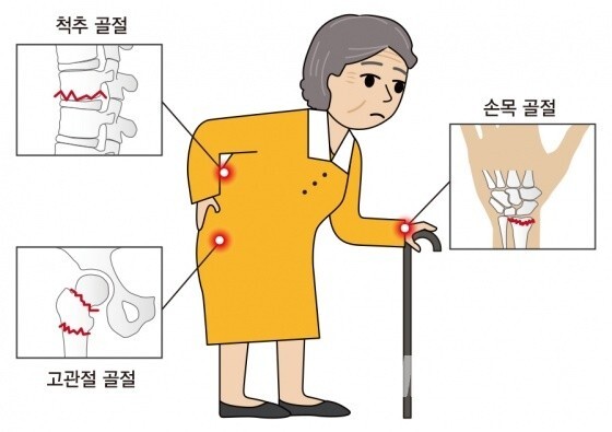  골다공증의 이해(원인, 위험 증상)