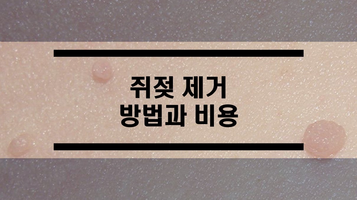  쥐젖 제거 방법과 비용