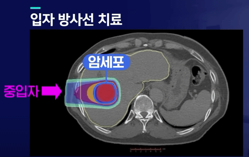 중입자-암치료-방법