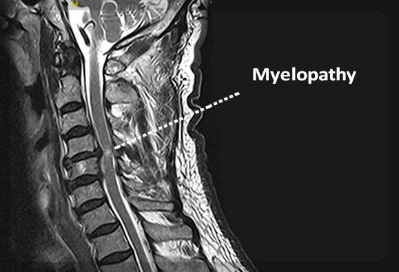 경추 척수병증의 경추 MRI 사진