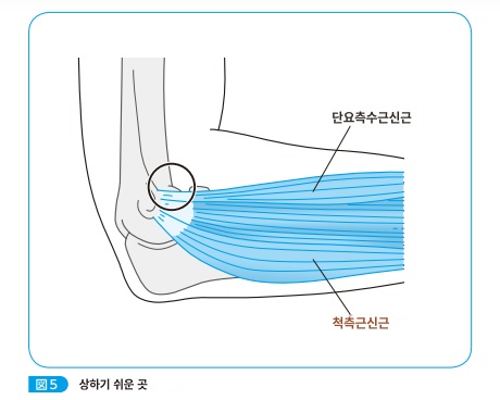  외측상 과염 (팔꿈치의 통증, 테니스 엘보)에 대해 알아보자 (1)