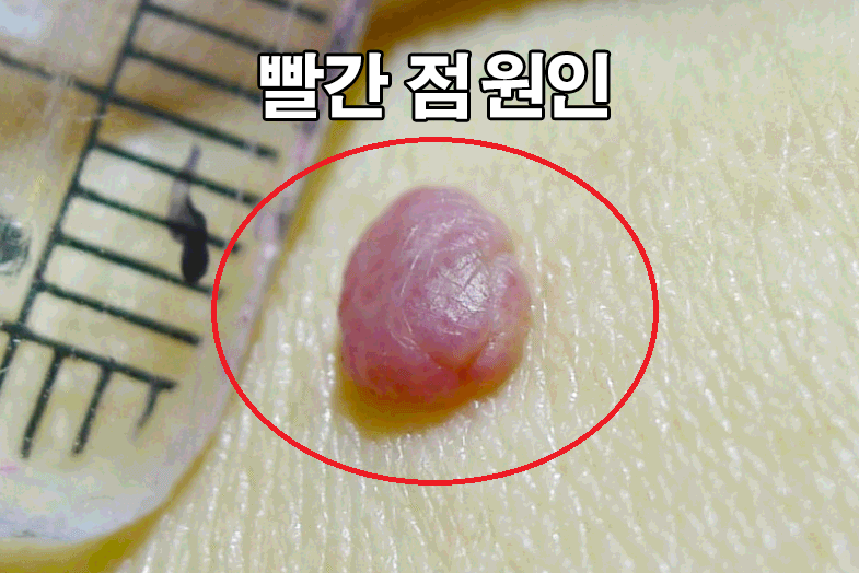  몸에 빨간 점 원인 6가지