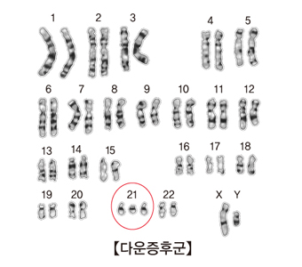 다운증후군 염색체(이미지 제공=서울아산병원)