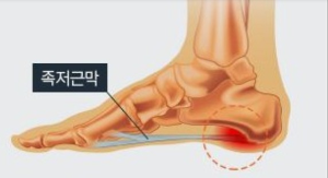 족저근막염