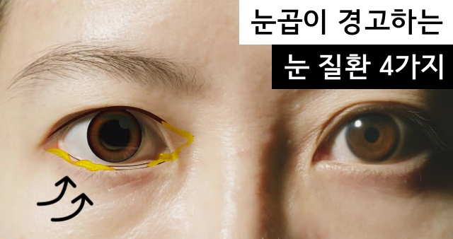 고름 노란 눈곱이 끼는 이유 눈질환 아폴로 눈병 결막염 증상 충혈, 건강 팁줌 매일꿀정보