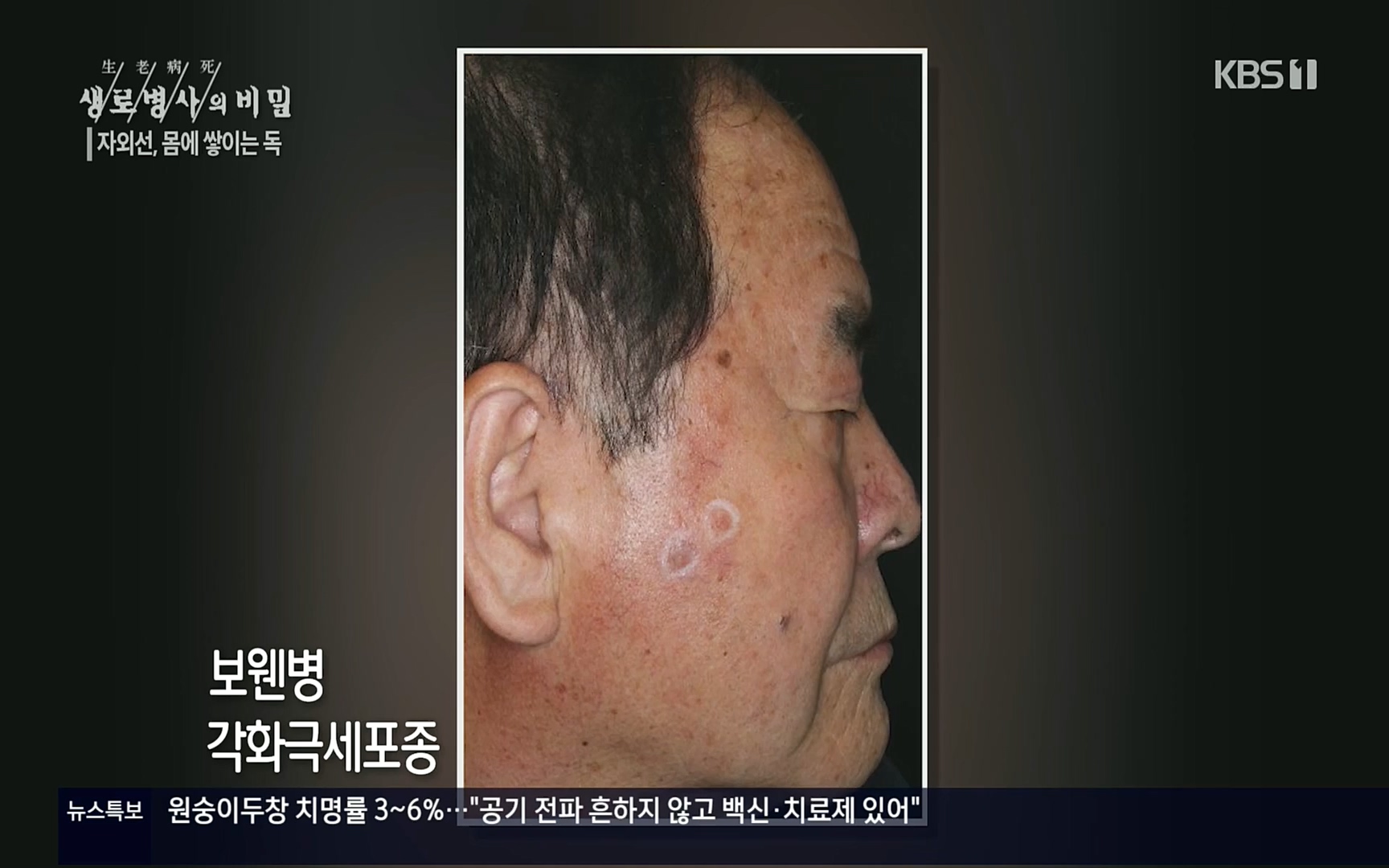 생로병사의 비밀.E824.220629p.H264-F1RST.mp4_20220630_203754.918.jpg