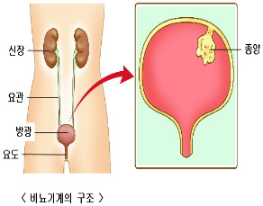 방광암 생존율&amp;#44; 방광암 초기증상