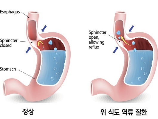  역류성 식도염 정의와 원인 및 치료 방법