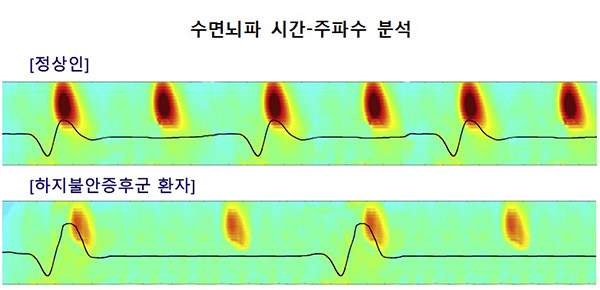 하지불안 증후군 증상