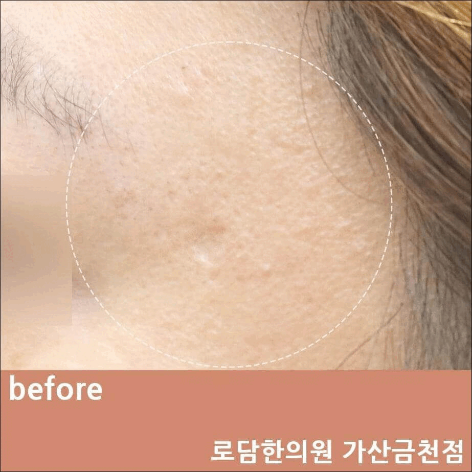  관자놀이 여드름 자국 패인 흉터 새살침 코라테라피 치료 과정