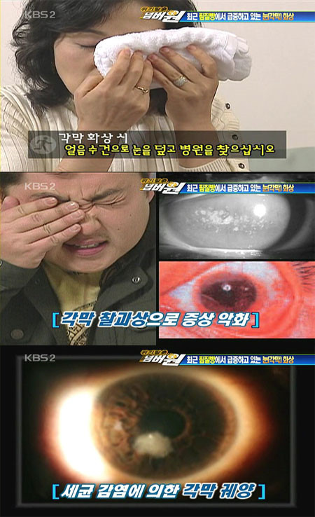  눈에 본드가 들어갔을 때 어떻게 해야 하나요?(각막 화상)
