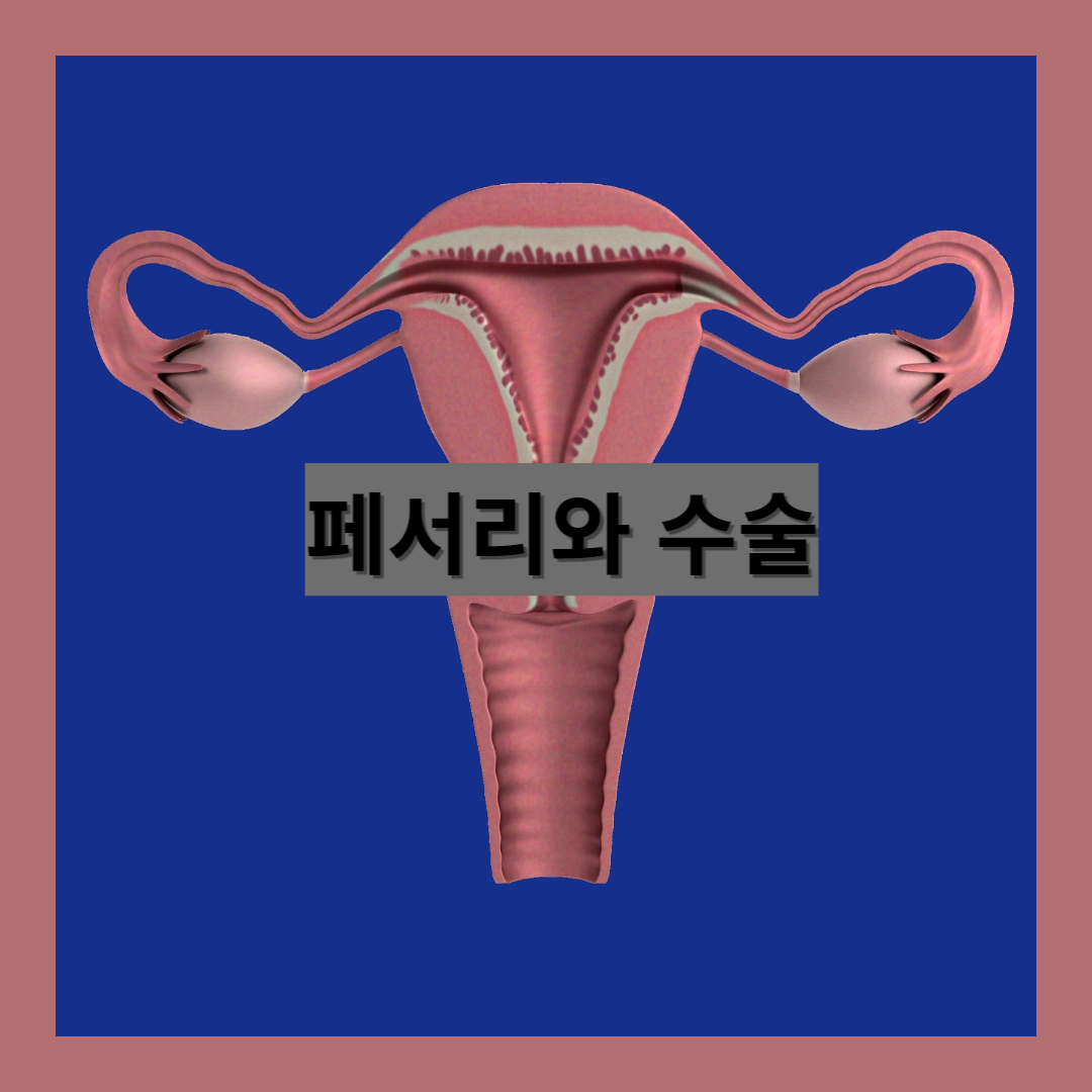 페서리와 수술