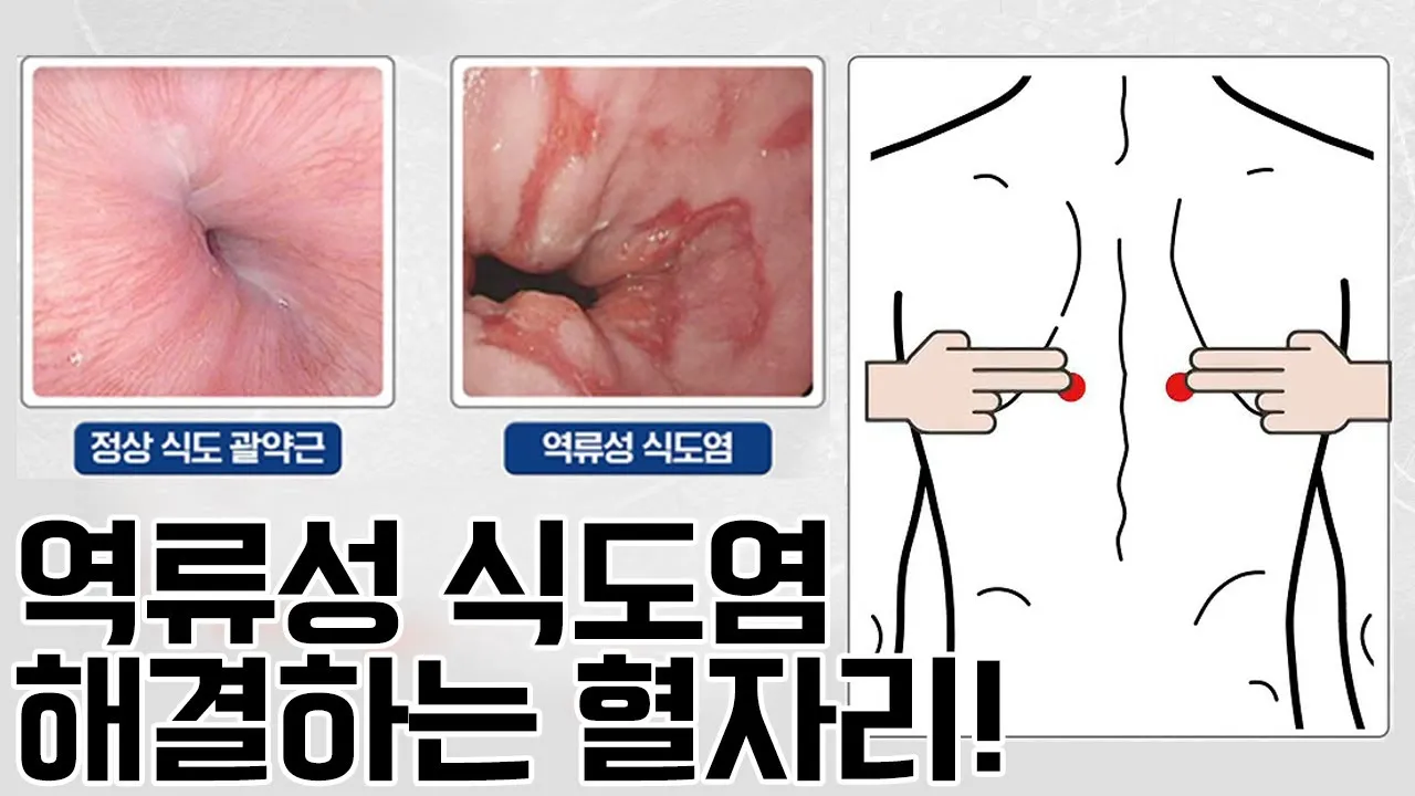 식도염에 좋은 음식 안좋은 음식_8