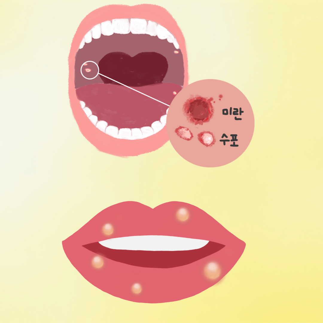 구내염 관련 그림