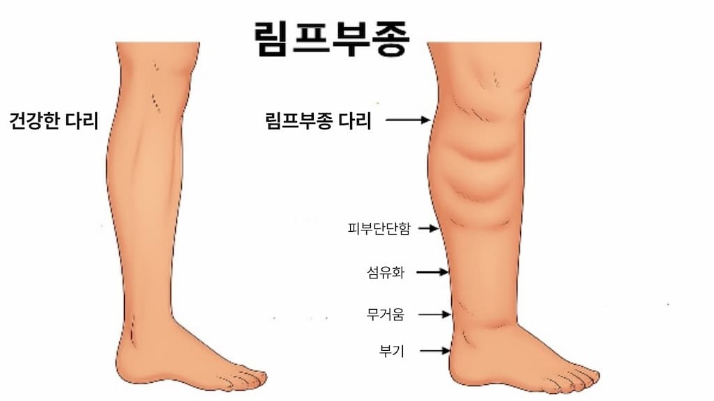 림프부종을 설명하기 위한 의학 일러스트로, 왼쪽은 정상 다리, 오른쪽은 림프부종이 발생한 다리를 비교하여 보여준다. 오른쪽 다리는 피부가 두꺼워지고 부어 있으며, 불편감과 무거움 등의 증상을 나타낸다