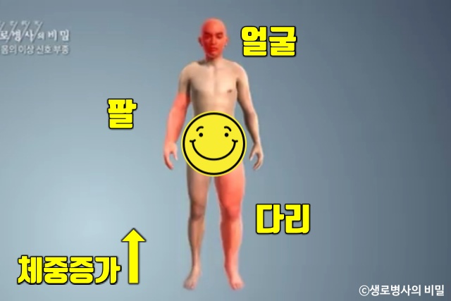 종아리 얼굴 붓는 이유, 붓기 부기 부종 원인 증상, 생로병사의 비밀, 다이어트 건강, 팁줌 매일꿀정보