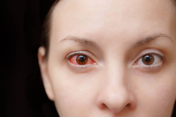 눈 실핏줄 터짐 이유와 증상 및 치료 방법