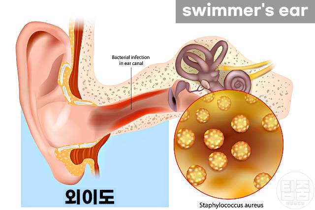 귀에 물 들어가면 귀 통증 염증 외이도염 중이염