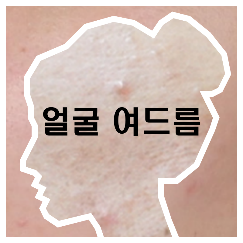  얼굴 여드름 - 극복 후기