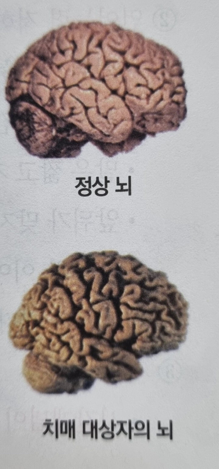 정상인-뇌와-치매-환자의-뇌-비교-사진