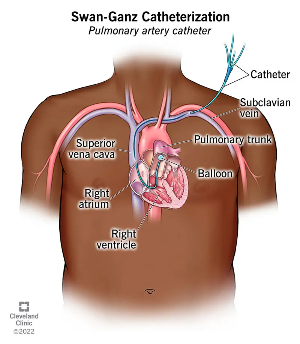 pulmonary artery catheter