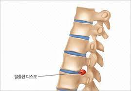 허리디스크 증세