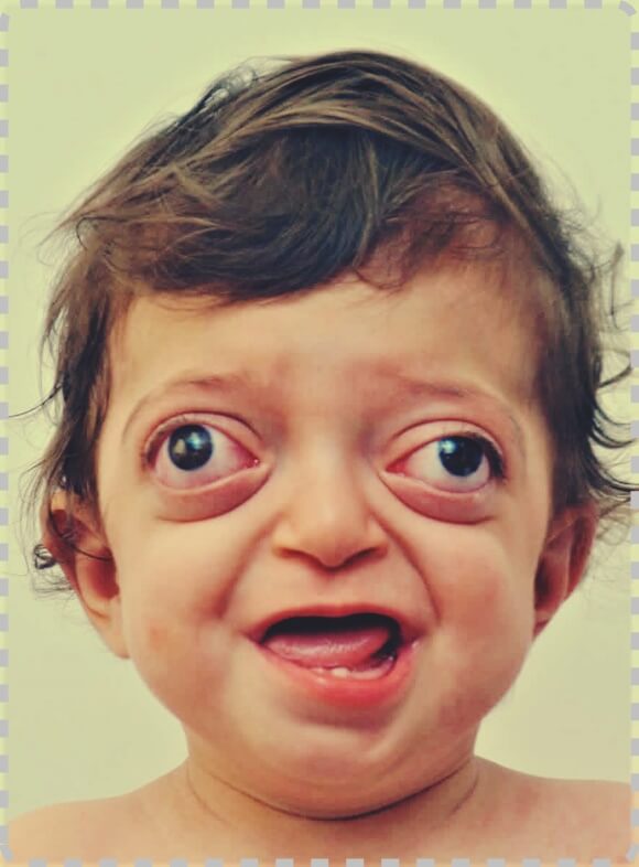 크루존 증후군(Crouzon Syndrome)