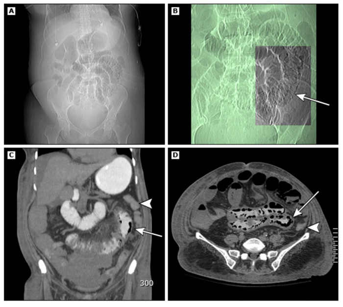 창자벽 공기낭증 xray CT 사진