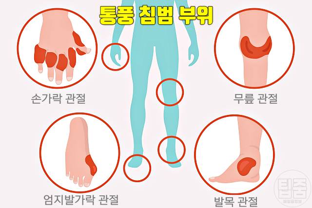 통풍 초기증상 엄지발가락 통증 원인 통풍 증상 손가락 손목 무릎 발목