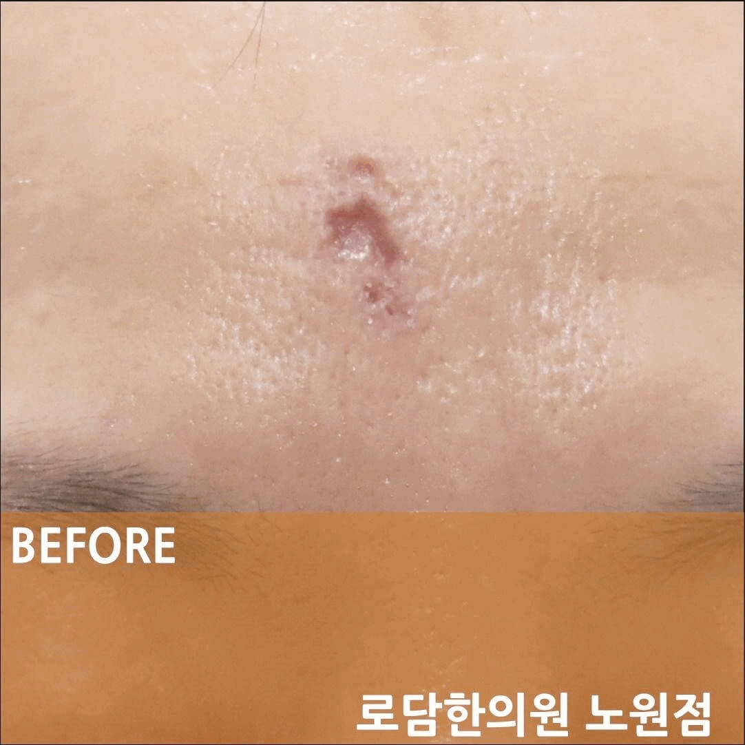  대상포진 자국 패인 흉터 한의원 새살침 코라테라피 치료 과정
