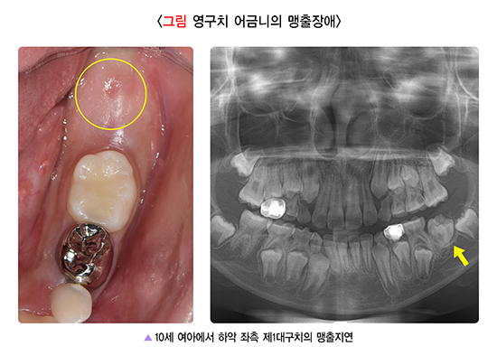  치아맹출장애