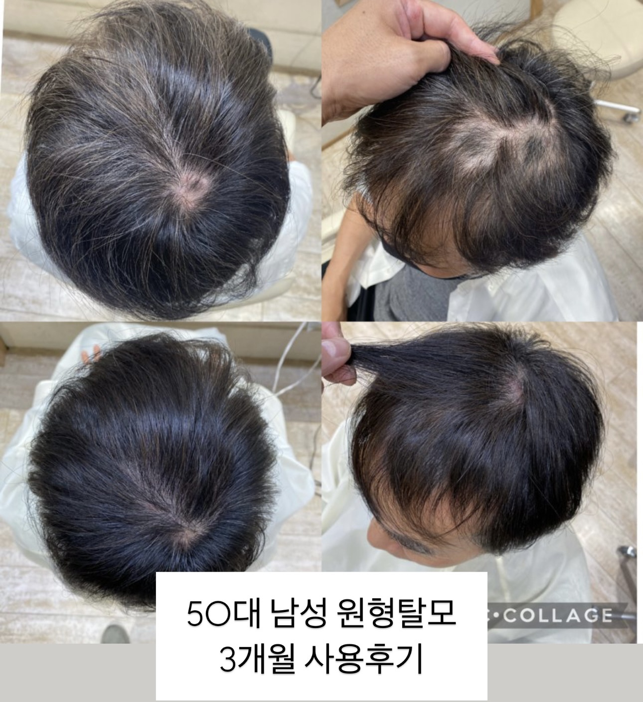 강발헤드스파후기 강발헤드스파효과 남자탈모치료 남성탈모치료 강발HSC 강발헤드스파앰플 줄기세포탈모치료 시스헤어 지예가 남성탈모치료방법
