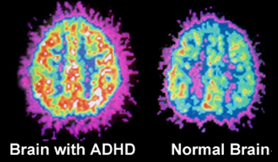 normal-brain-and-adhd-brain-differences