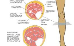 종아리-근육-통증-구획증후군