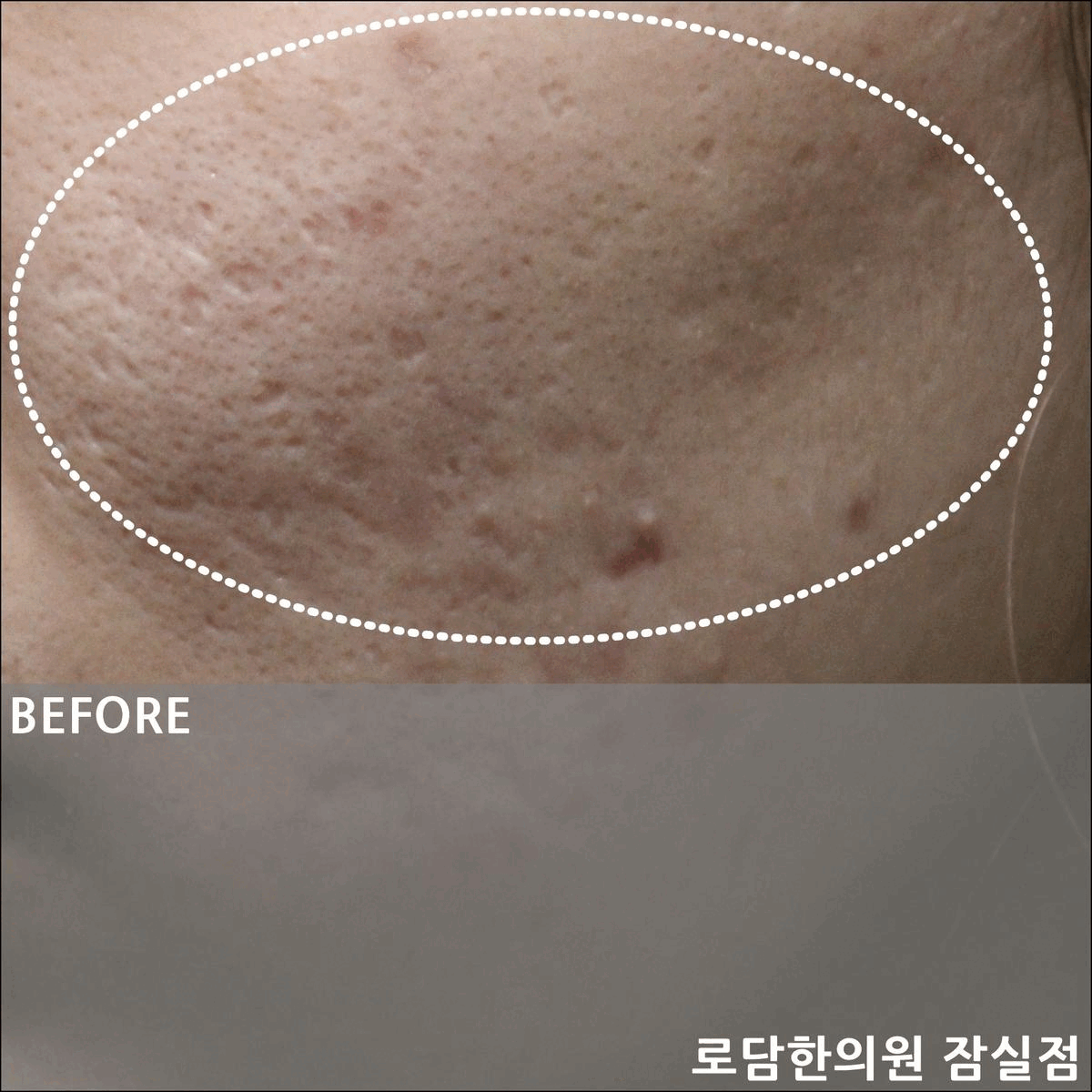  잠실 여드름 흉터 피부과가 아닌 한의원 새살침으로