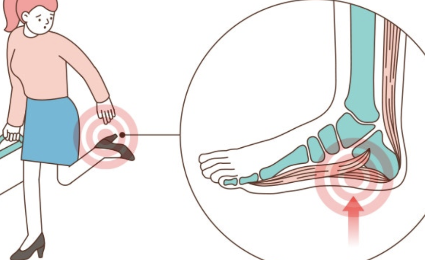 족저 근막염 2