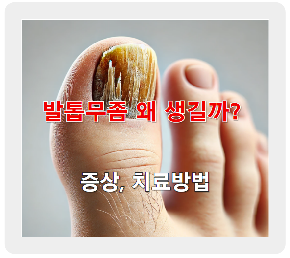 발톱무좀 증상, 치료 방법, 그리고 완치하는 법 알아보기