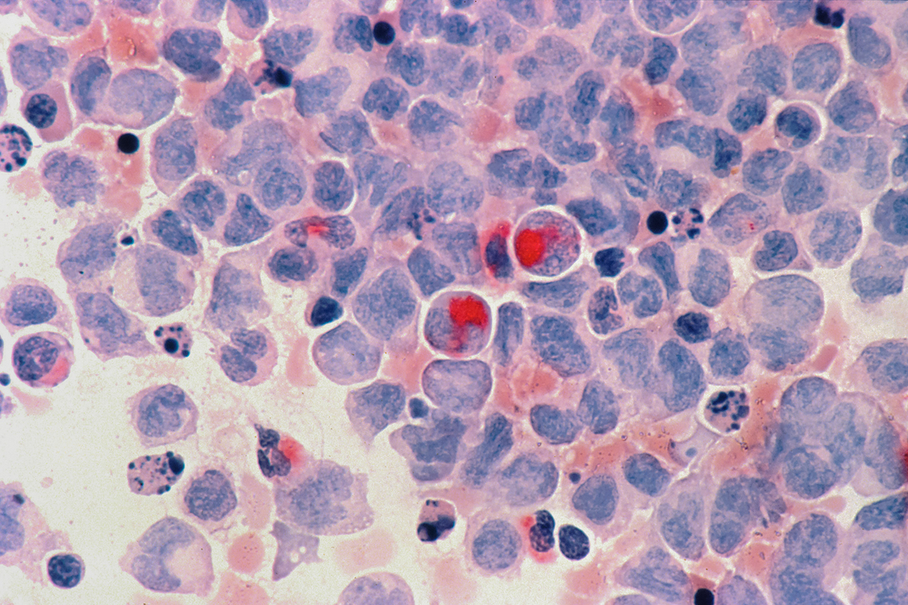 피 한방울로 암 진단 가능 바이오센서 개발