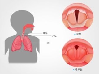  후두염 증상