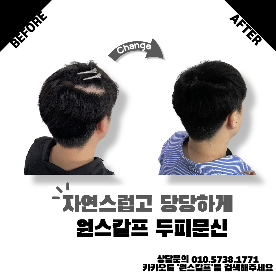  부산 땜빵문신 흉터커버 SMP 믿고 맡겨주세요.